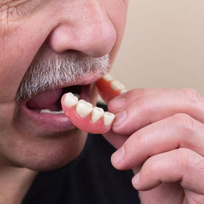 Prothèse dentaire amovible partielle pour remplacer plusieurs dents