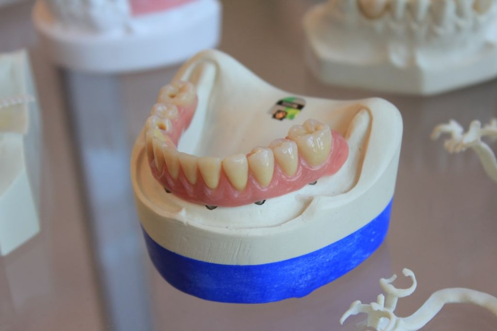 Prothèse dentaire totale amovible pour remplacer toutes les dents d'une arcade
