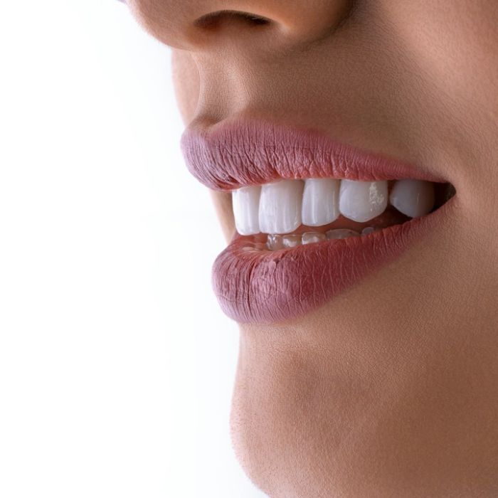 Facettes ou couronnes sur les dents de devant : comment choisir ?