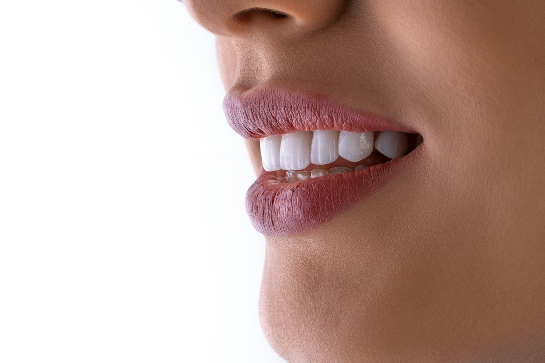 Sourire montrant les dents antérieures, illustration du choix entre facettes et couronnes