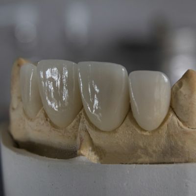 Restaurations céramiques antérieures sur un modèle de laboratoire — photo illustrative