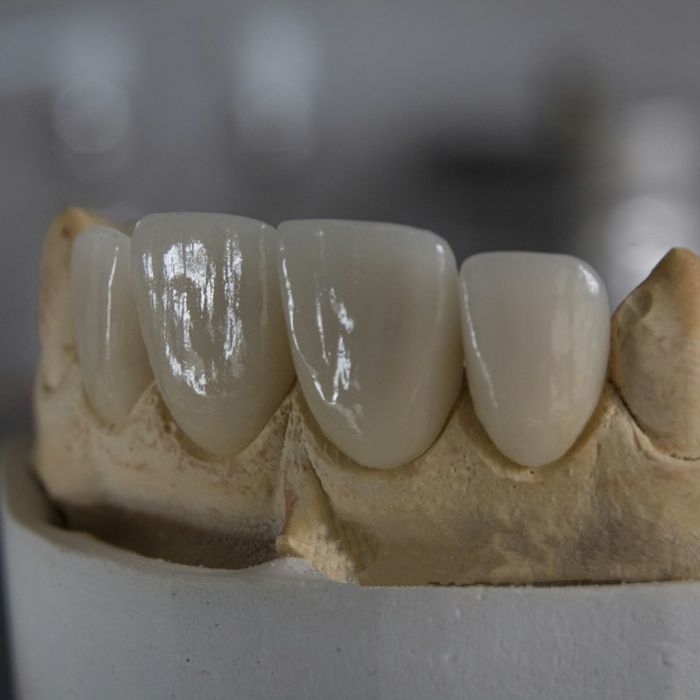 Couronne en zircone ou en céramique E-max : quelles différences ?